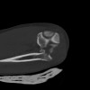 SPORK, NICO - 22.03.1976 - 02.08.2022 - CT obere Extremität - 18:02:23